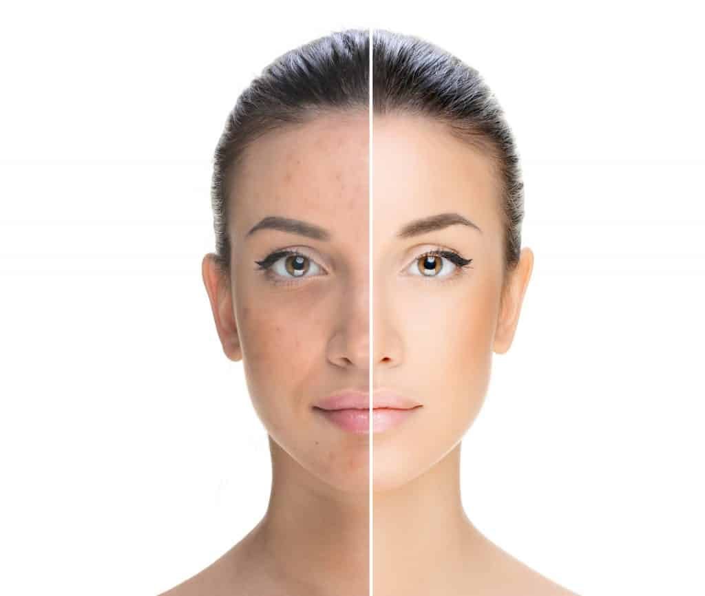 Acne and Pigmentation Treatment